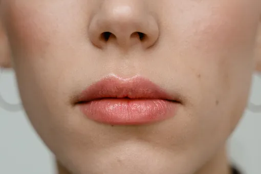 Хейлит (хейлоз) — заболевание, при котором наблюдается побледнение губ