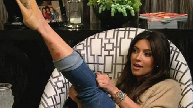 Ким Кардаьшян показывает очаг псориаза на ноге